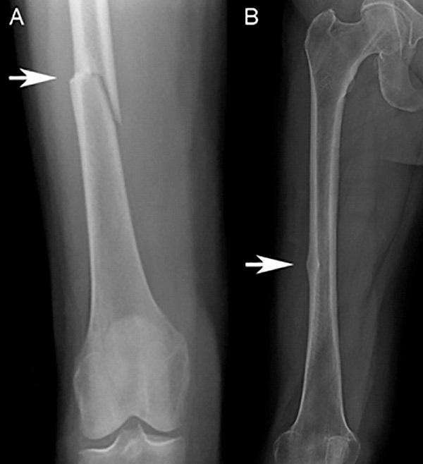 Atypical femoral fracture