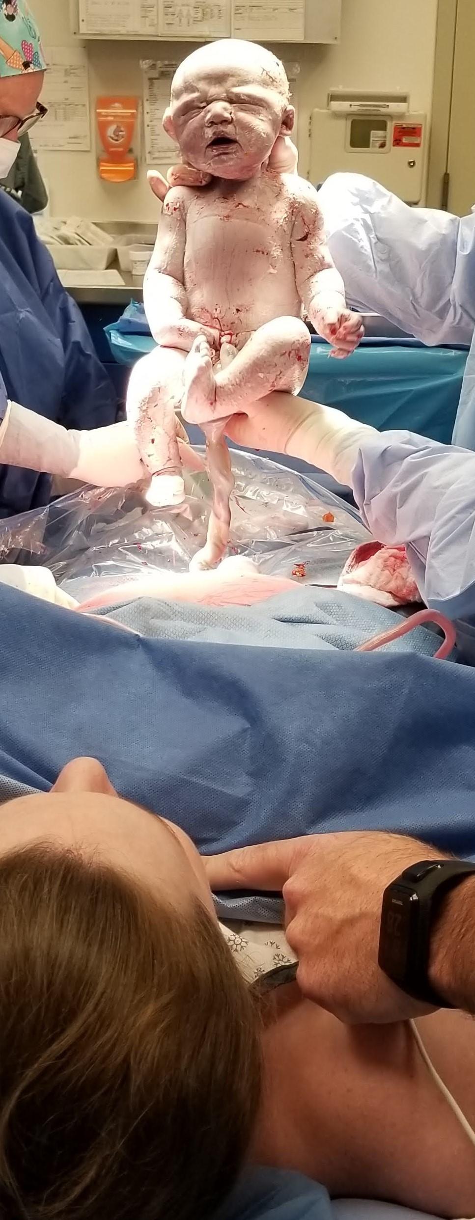 Lydia’s caesarean birth